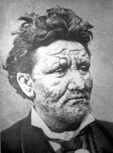 Leprosy 1886